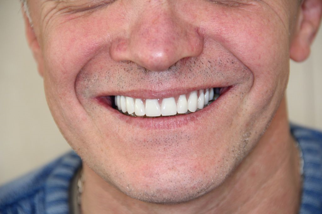 Протезист спб. Имплантация верхних зубов.